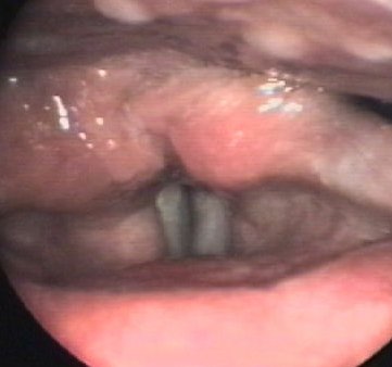 B 非良性の声帯の病気