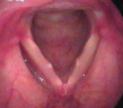 B 非良性の声帯の病気