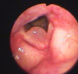 B 非良性の声帯の病気